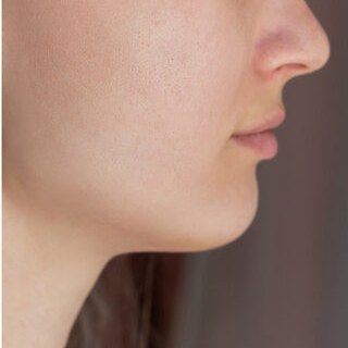 After — smoother, clearer skin