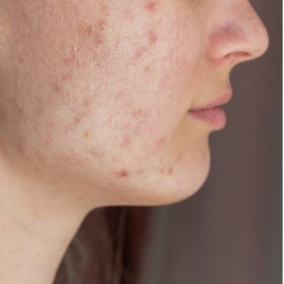 Before — uneven, blemished skin